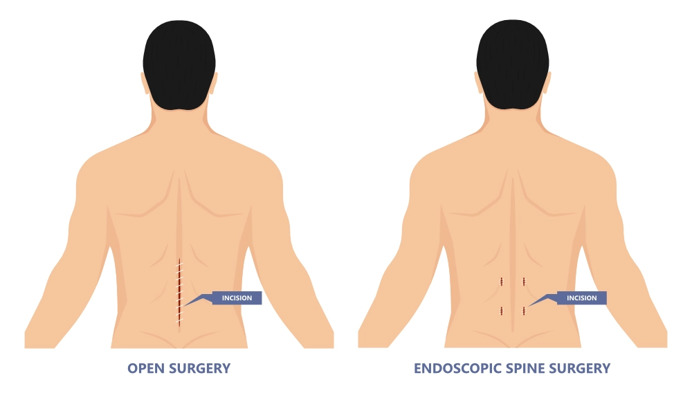 A graphic showing the differences in open surgery and endoscopic spine surgery. Traditional spine surgery comes with post-operative pain, while endoscopic spine surgery offers a small incision and less pain than traditional spinal surgeries.