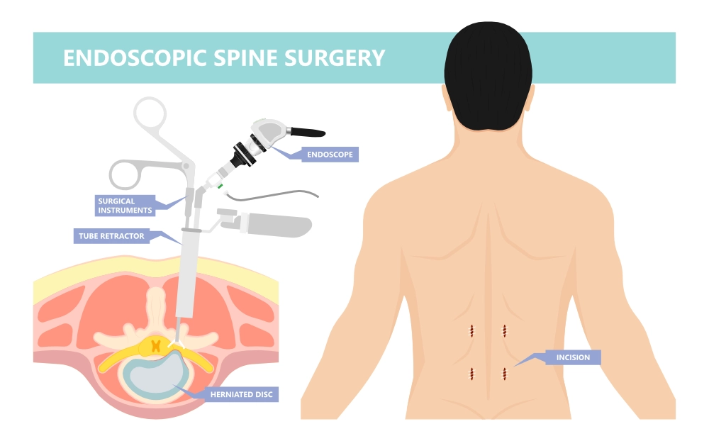 A graphic showing the endoscopic spinal surgery process
